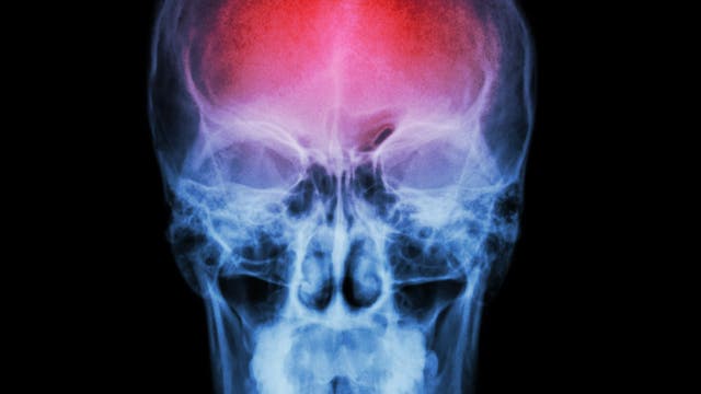 X ray skull and stroke