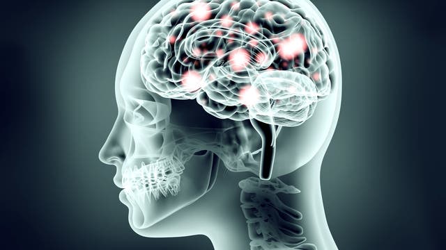 3D-Illustration: Eine Figur mit durch den Schädel sichtbarem Gehirn unter Strom