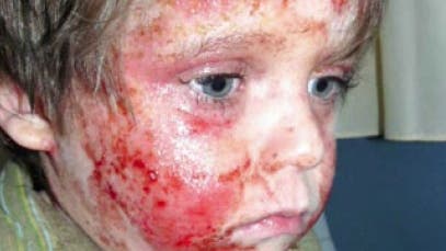 Kinder mit Neurodermitis haben eine so trockene Haut, dass diese schon auf kleinste Reizungen wie Schweiß, Seife oder scheuernde Kleidung mit Entzündungen reagiert.