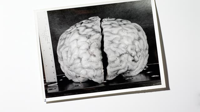 Einsteins Gehirn: Frontalansicht