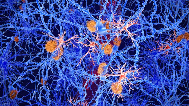 Illustration von Neuronen mit blauen Zellkörpern und verzweigten Dendriten, die durch ein Netzwerk verbunden sind. Zwischen den Neuronen sind orangefarbene Plaques sichtbar, die auf amyloide Ablagerungen hinweisen könnten, wie sie bei neurodegenerativen Erkrankungen vorkommen. Der Hintergrund ist dunkelblau, wodurch die Strukturen hervorgehoben werden.