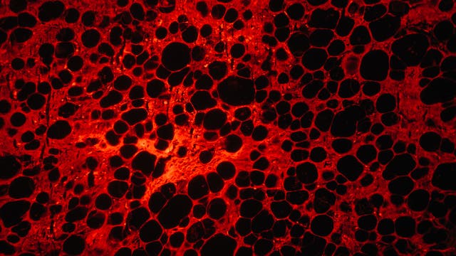 Im Bild zu sehen sind Liposarkomzellen, hier rot markiert durch Fluoreszenzfärbung.