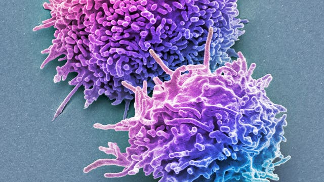 Zwei farbverstärkte, elektronenmikroskopische Aufnahmen von Zellen, die eine unregelmäßige, stachelige Oberfläche aufweisen. Die Zellen sind in lebhaften Violett- und Blautönen dargestellt und heben sich deutlich vom grauen Hintergrund ab. Die Struktur der Zellen zeigt zahlreiche Ausstülpungen, die an Tentakel erinnern.