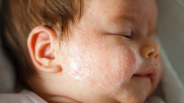 Ein schlafendes Baby liegt auf der Seite. Die Nahaufnahme zeigt das Gesicht des Babys mit geschlossenen Augen und einem sanften Ausdruck. Die Haut des Babys ist mit einer leichten Creme bedeckt. Das Bild vermittelt Ruhe und Geborgenheit.