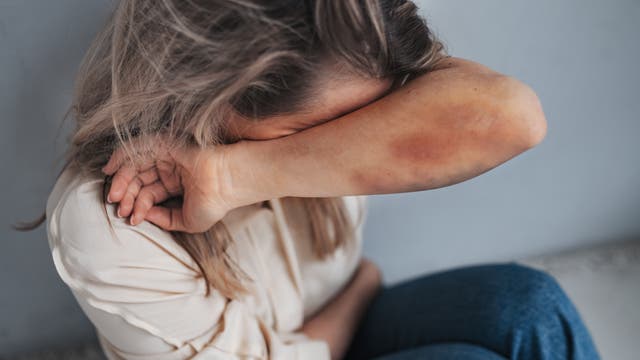 Eine Person sitzt mit angewinkelten Beinen und verbirgt ihr Gesicht in ihrem Arm. Der Arm zeigt sichtbare blaue Flecken. Die Person trägt ein helles Oberteil und Jeans. Die Szene vermittelt einen emotionalen Ausdruck von Schutz oder Traurigkeit.