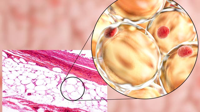Eine mikroskopische Aufnahme von menschlichem Fettgewebe, das in einem Querschnitt dargestellt ist. Links zeigt das Bild eine histologische Färbung mit weißen Fettzellen, die als große, runde Strukturen erscheinen, umgeben von rosa gefärbtem Bindegewebe. Ein vergrößerter Ausschnitt, bei dem es sich um eine  computergenerierte Illustration handelt, hebt die Struktur der Fettzellen hervor, die als große, gelbliche Kugeln mit roten Zellkernen erscheinen. Die Darstellung verdeutlicht die Anordnung und Beschaffenheit von Fettgewebe auf zellulärer Ebene.