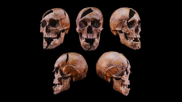 Ein wissenschaftliches Diagramm zeigt fünf Ansichten eines menschlichen Schädels vor einem schwarzen Hintergrund. Die Ansichten umfassen zwei seitliche, eine frontale und zwei diagonale Perspektiven. Der Schädel weist sichtbare Brüche und Verletzungen auf. Die Struktur der Schädelknochen und die Zahnanordnung sind deutlich erkennbar.