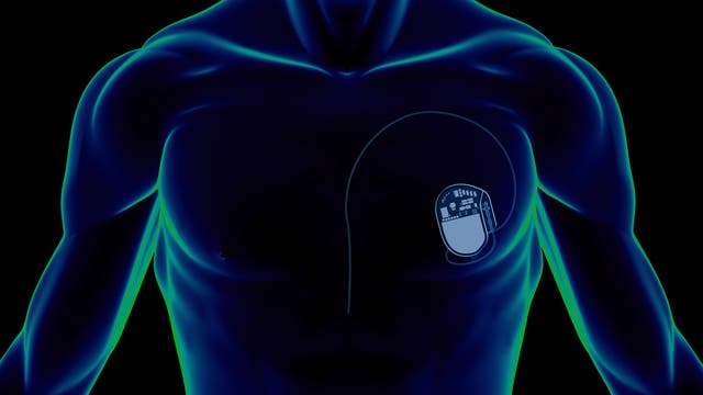 Herzschrittmacher in der Brust