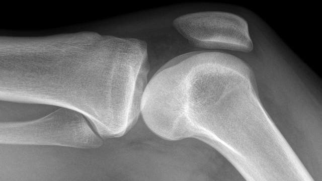 Kniegelenk im Röntgenbild