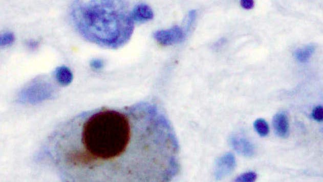 Lewy-Körper in der Substantia Nigra eines Parkinson-Kranken