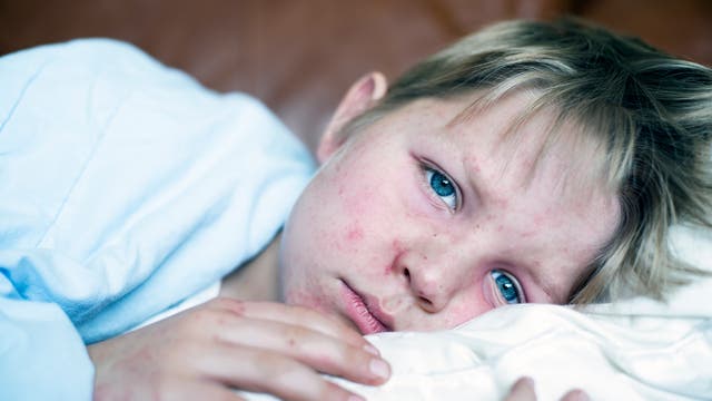 Junge liegt mit Masern krank im Bett (Archivbild)