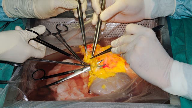 Ärzte bereiten eine Nierentransplantation vor