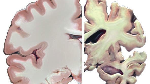 Gehirn von Alzheimerpatient im Vergleich
