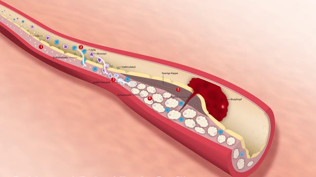 Ablagerung an einer Arterienwand