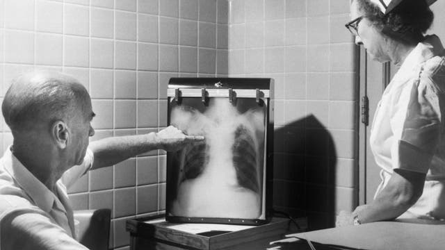 Röntgendiagnose Tuberkulose