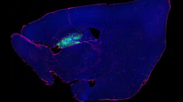 Glioblastom im Hirn einer Maus