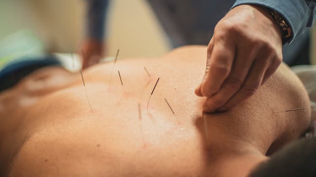 Auf einem Rücken sind mehrere Akupunkturnadeln gesetzt