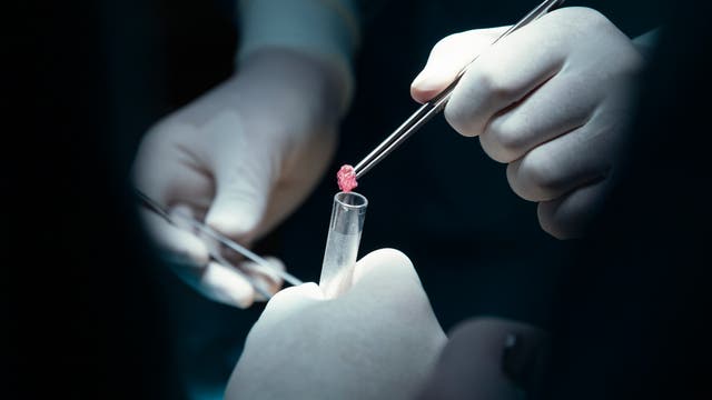 Eine Biopsieprobe wird mit einer Pinzette in ein Reagenzglas überführt.