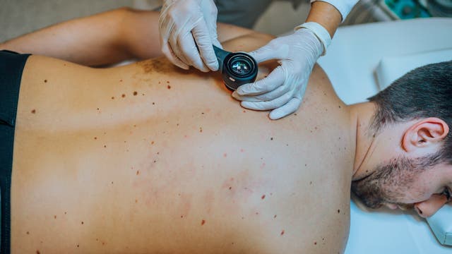 Ein Mann liegt oberkörperfrei auf dem Bauch auf einer Liege. Seine Pigmentflecken auf dem Rücken werden mit einem Dermatoskop untersucht. 