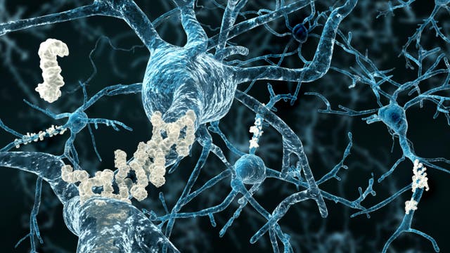 Amyloid-Plaques an Nervenzellen bei Alzheimer