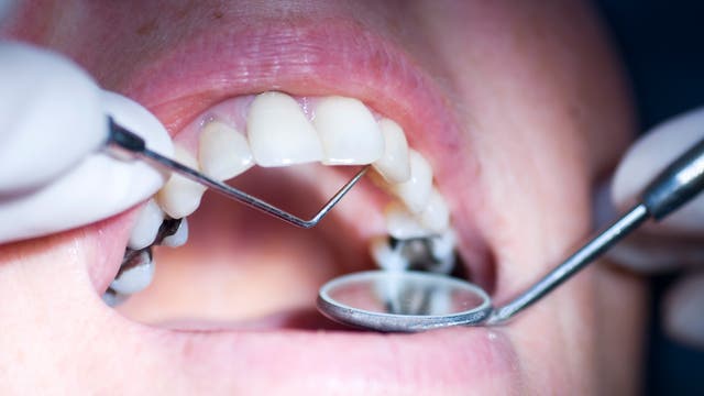 Geöffneter Mund während Zahnbehandlung