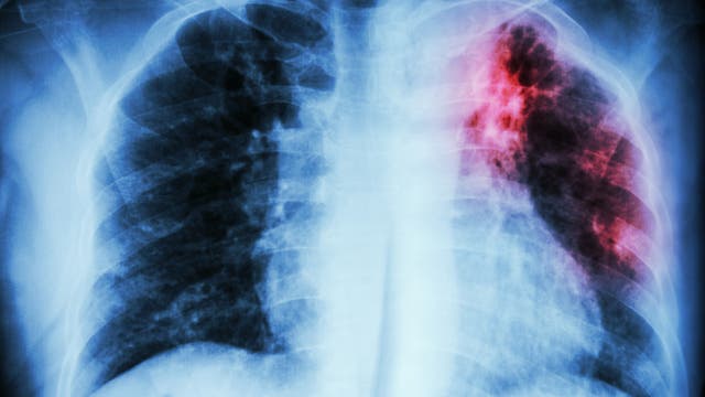Tbc-Infektionen lassen sich unter anderem als Schatten auf der Lunge erkennen.