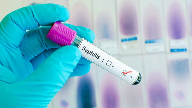 Röhrchen mit positivem Syphilis-Test