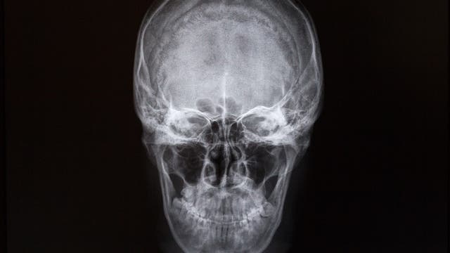 Schädel im Röntgenbild