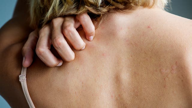 Mit Hautausschlägen oder Juckreiz beginnen etliche Autoimmunkrankheiten. Oft trifft es Frauen.
