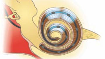 Cochlea-Implantat überträgt Schallsignal auf Hörschnecke