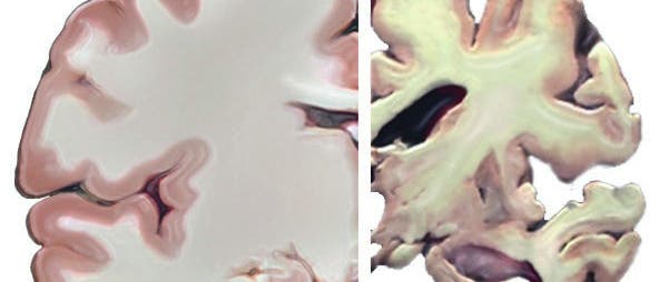 Alzheimerhirn Alzheimerhirn