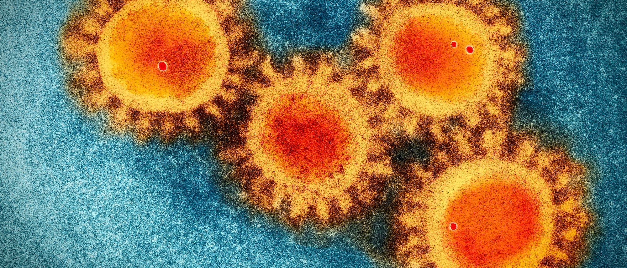 Eine mikroskopische Aufnahme zeigt das Coronavirus Sars-Cov-2. Eine mikroskopische Aufnahme zeigt das Coronavirus Sars-Cov-2.