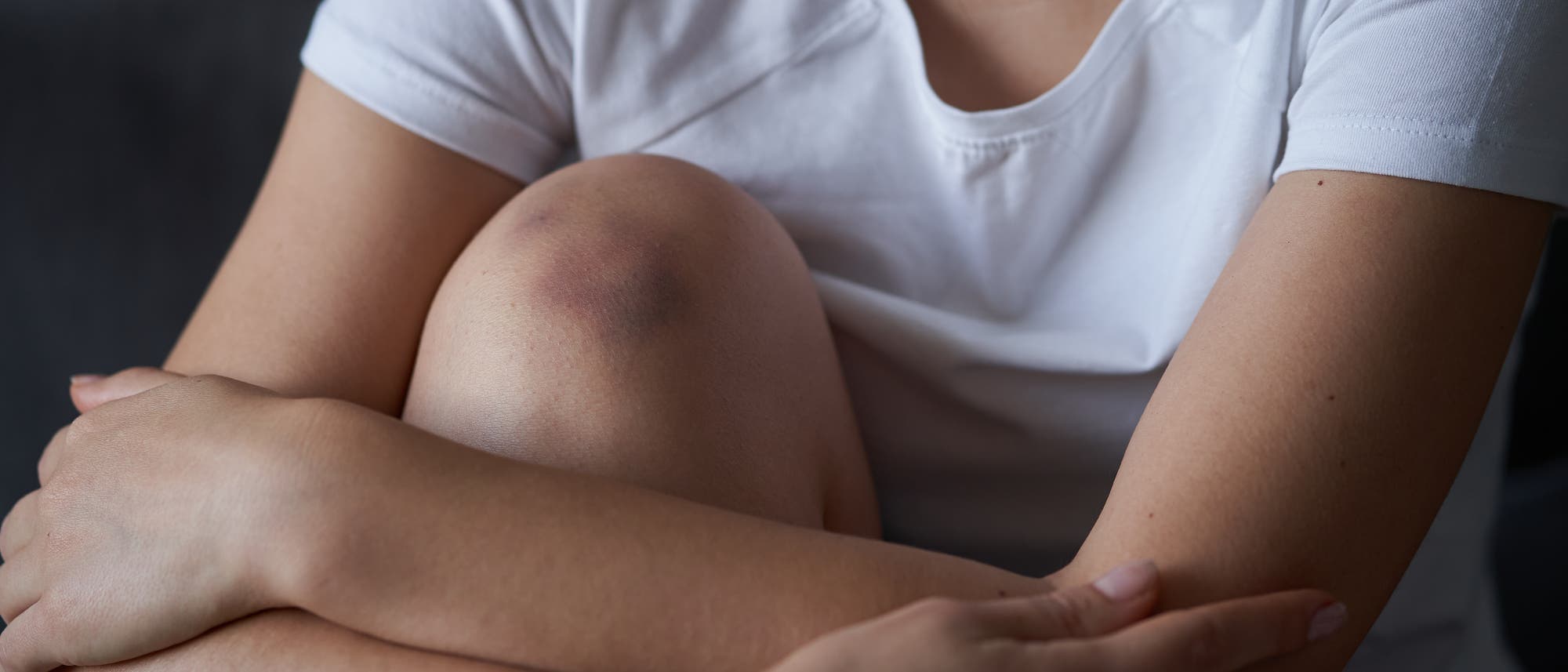Frau mit blauem Fleck am Knie Frau mit blauem Fleck am Knie