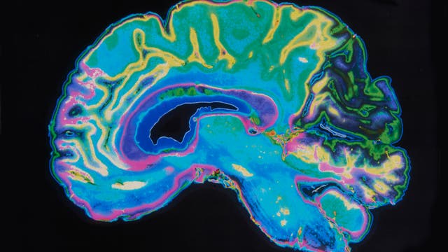 Magnetresonanzbild eines Gehirns