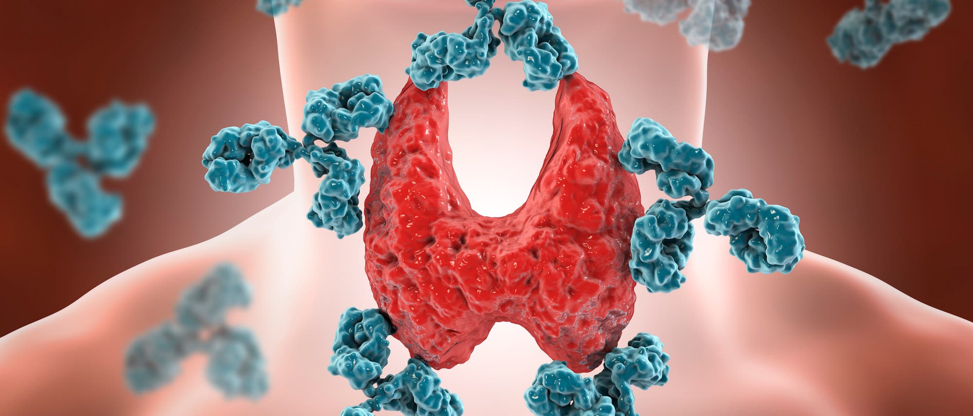 Hashimoto-Thyreoiditis Hashimoto-Thyreoiditis