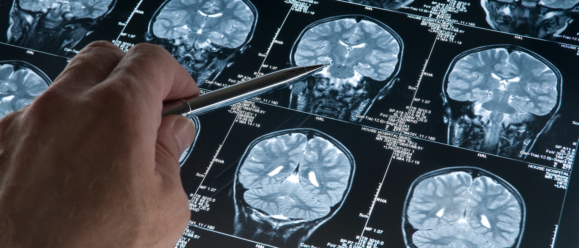 Gehirntumor auf CT-Scans