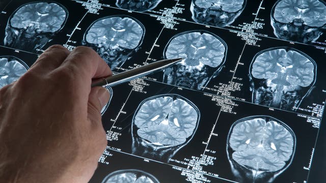Gehirntumor auf CT-Scans