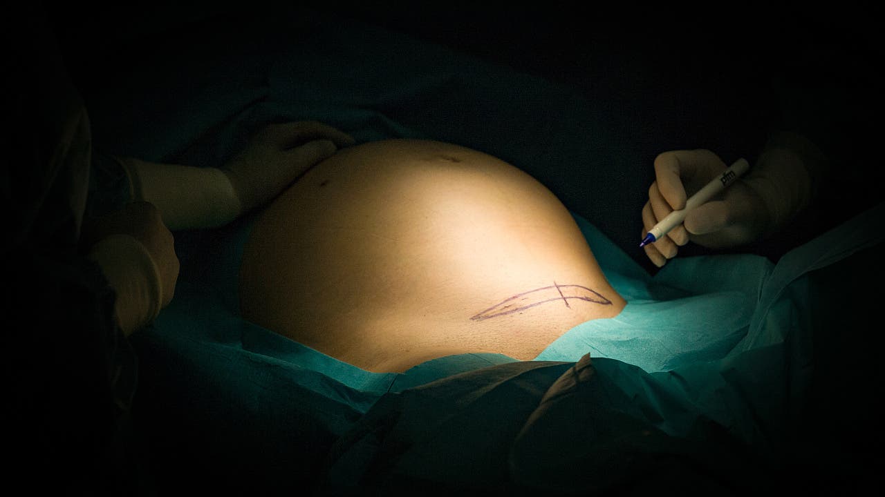 Frühe Präeklampsie: Blutwäsche kann Kaiserschnitt hinauszögern