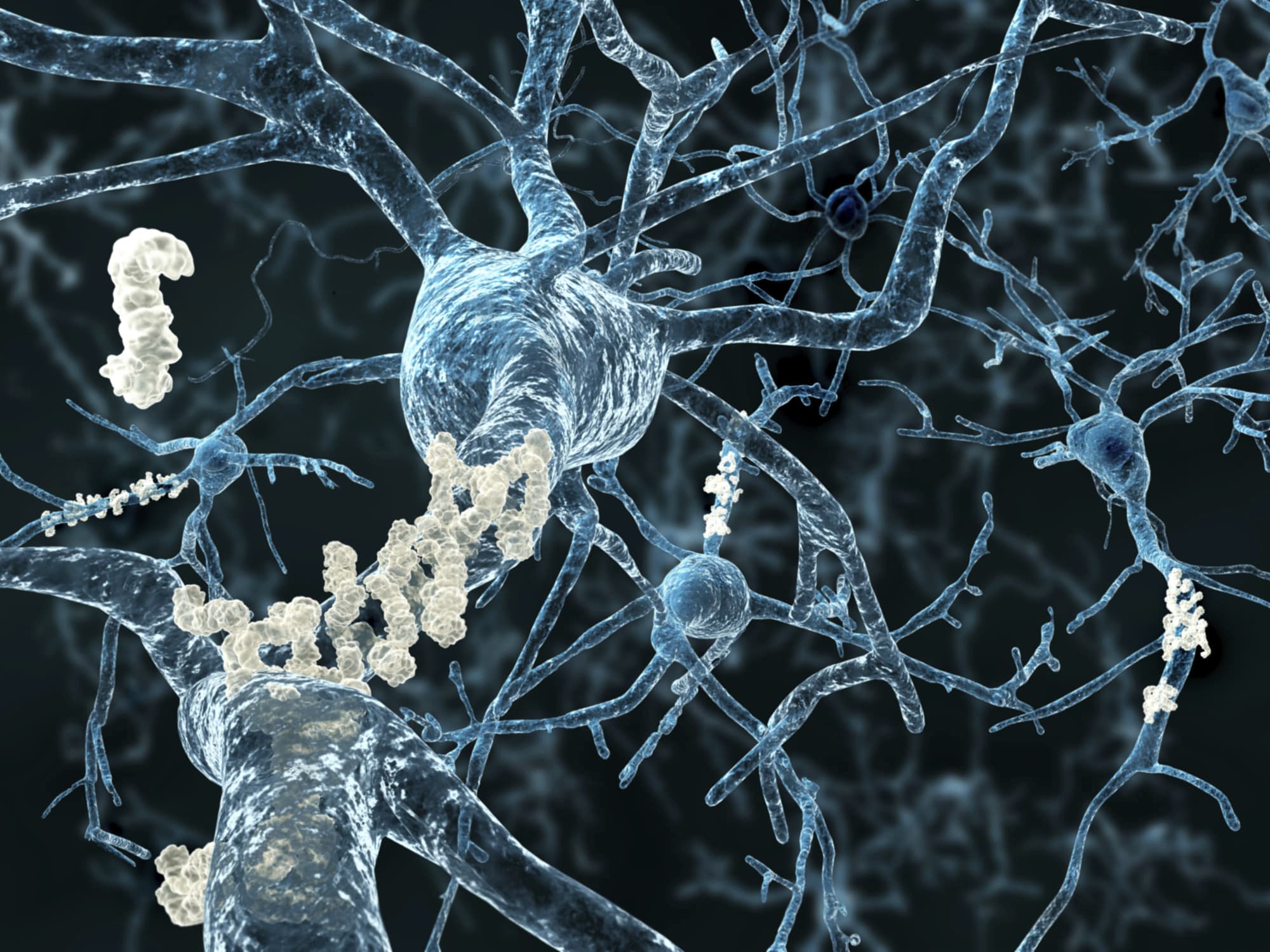 Alzheimer: Plaques zwischen Neuronen Alzheimer: Plaques zwischen Neuronen