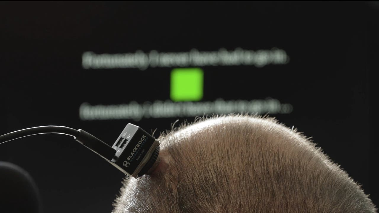 Sprach-Neuroprothesen: Wieder sprechen dank Hirnimplantat