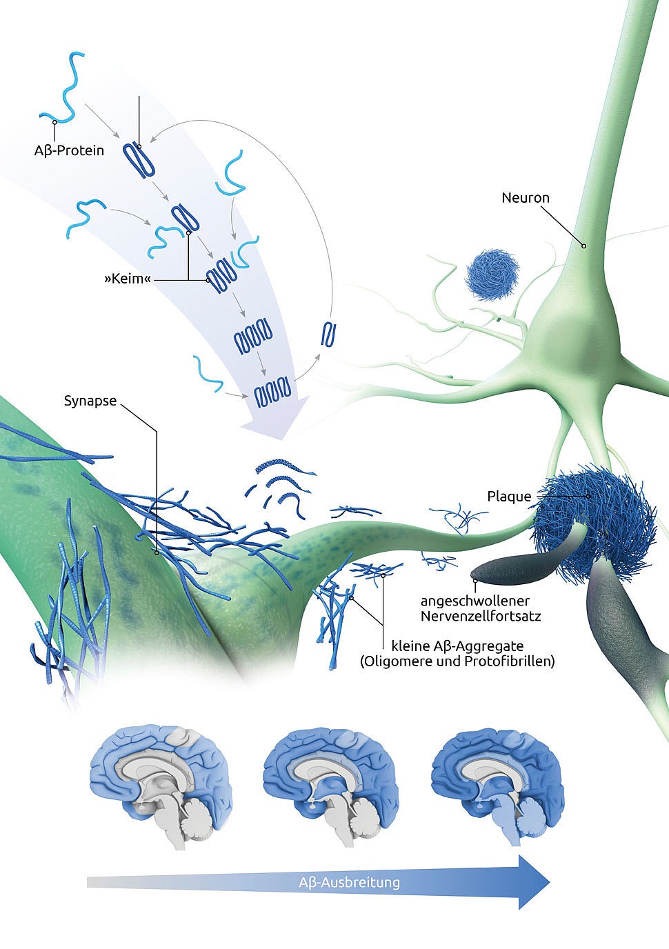 Ursache und Symptome von Alzheimer und Demenz Ursache und Symptome von Alzheimer und Demenz