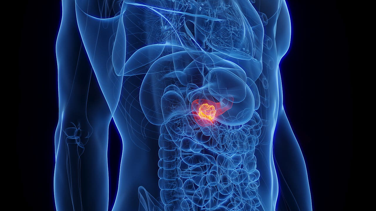 Medizinischer Durchbruch: Neue Pille verdoppelt Überlebenszeit bei Bauchspeicheldrüsenkrebs