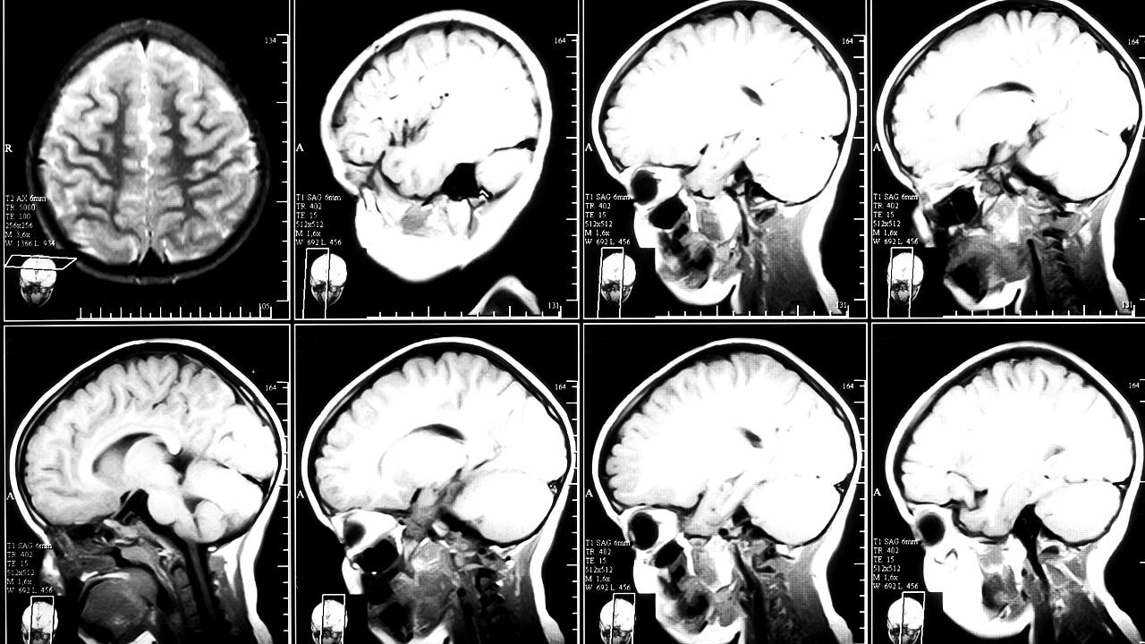 Forensische Neurologie: Das kriminelle Gehirn