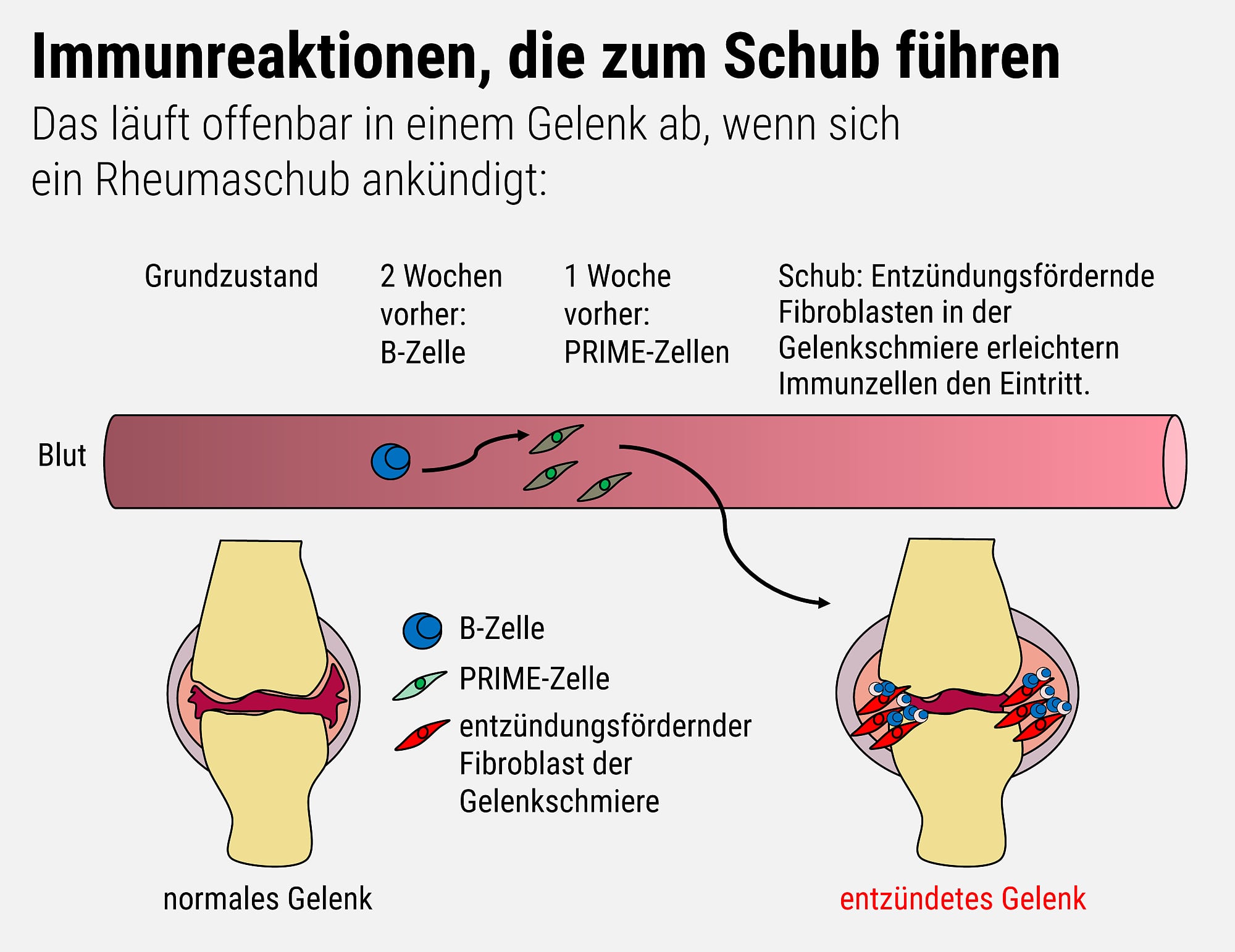 Rheuma: Neuer Zelltyp Sagt Schübe Voraus - Spektrum Der Wissenschaft