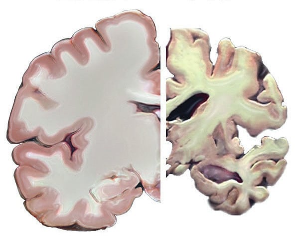 Gehirn von Alzheimerpatient im Vergleich Gehirn von Alzheimerpatient im Vergleich