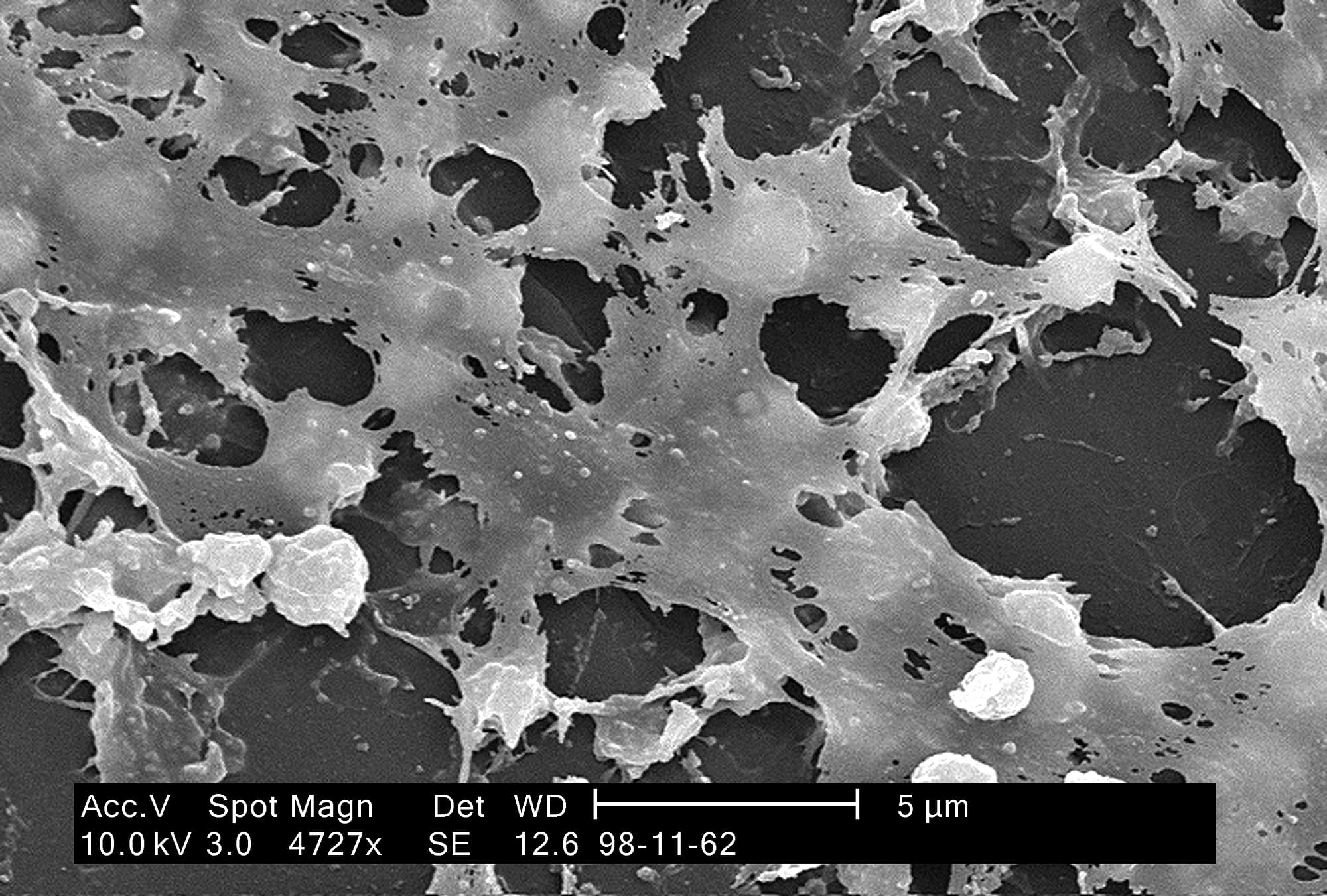 Biofilm auf einem Dauerkatheter Biofilm auf einem Dauerkatheter
