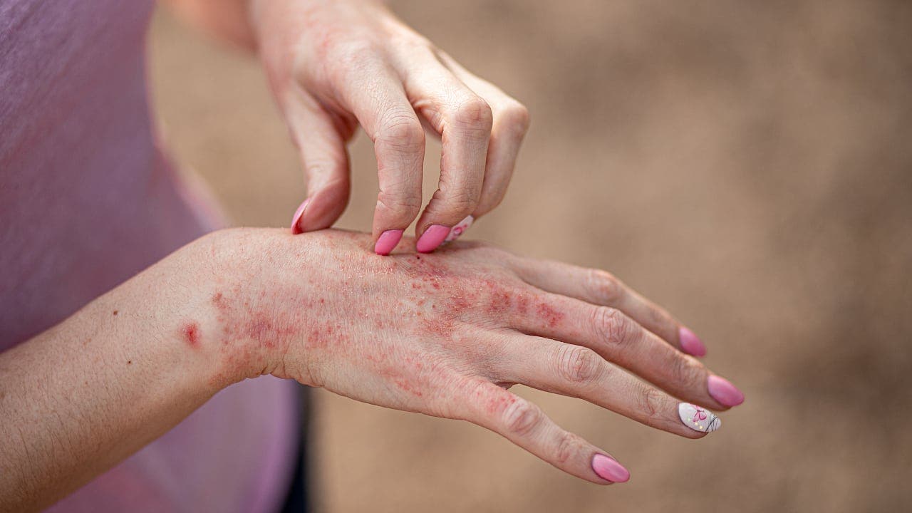 Chronisches Handekzem effektiv behandeln