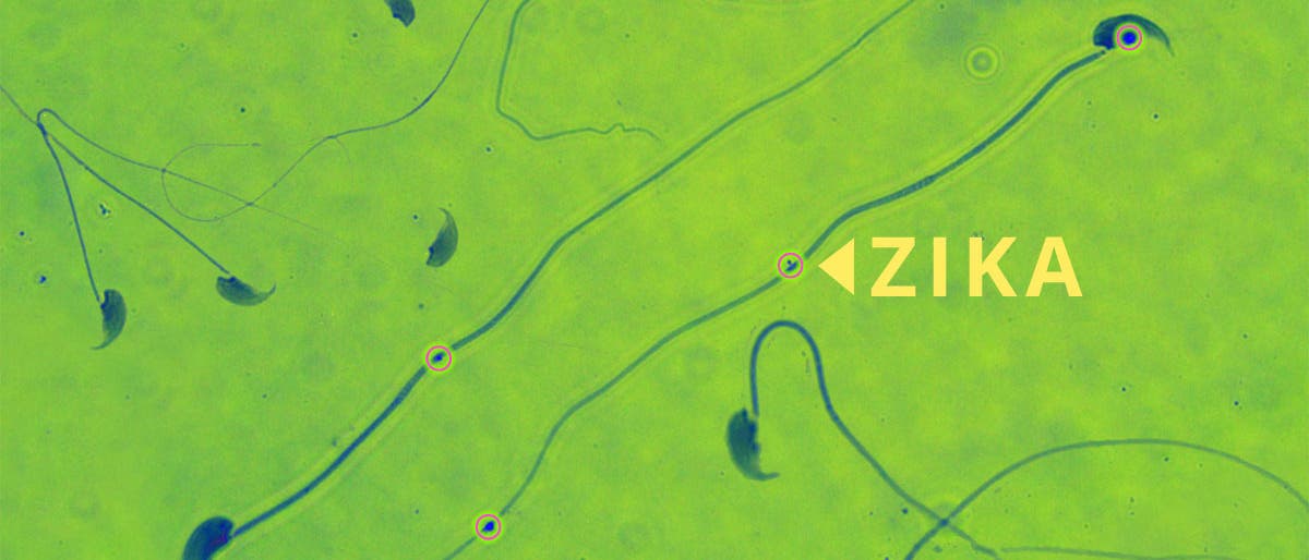 Zika in Spermien Zika in Spermien