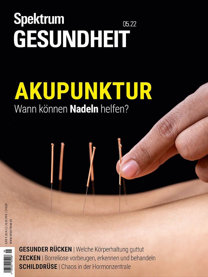  Akupunktur – Wann können Nadeln helfen?